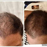 Hair restoration Service photo 4