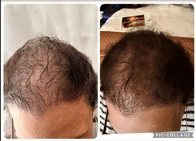 Hair restoration Service photo 4