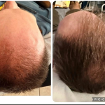 Hair restoration Service photo 5