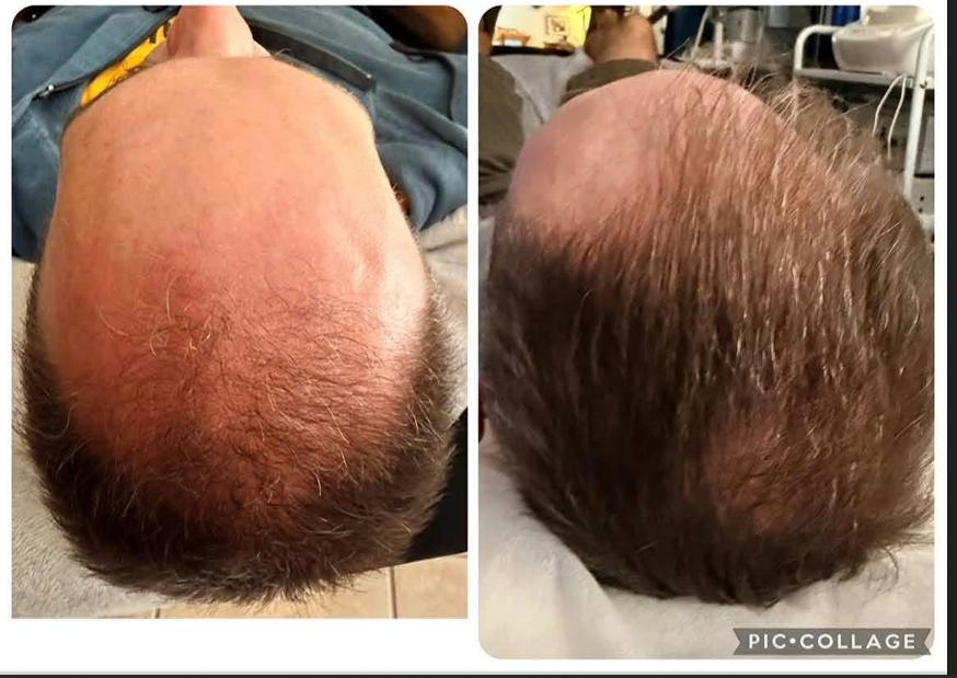 Hair restoration Service photo 5