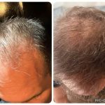 Hair restoration Service photo 1