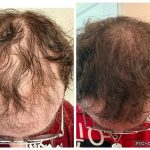 Hair restoration Service photo 6