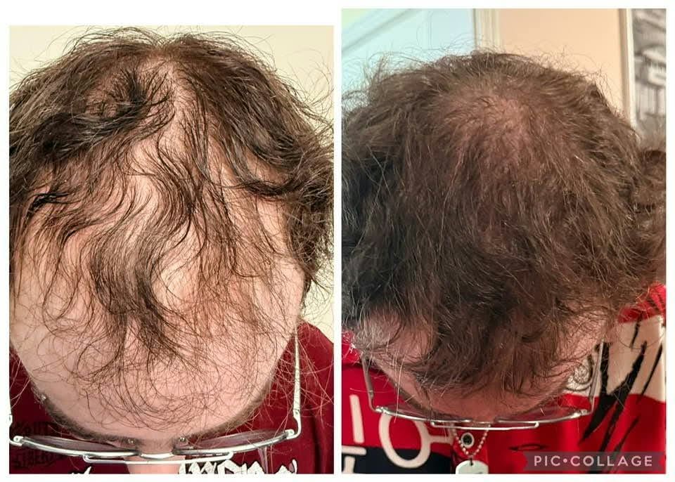 Hair restoration Service photo 6